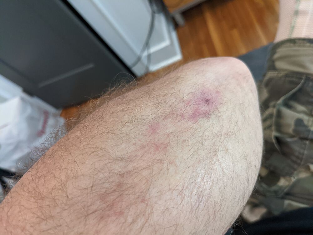 Compare the knee to this picture of my elbow, where I *was* wearing armor and hit at least as hard.